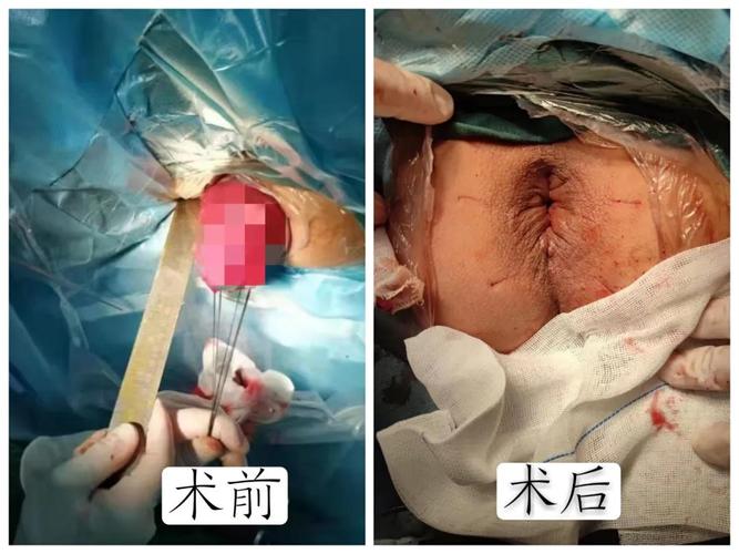 我院成功开展首例altermeier新技术治疗重度直肠脱垂