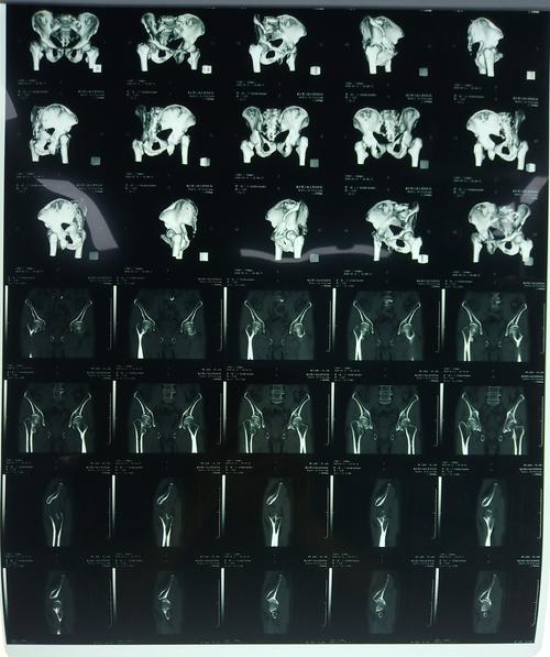 黔江创友骨科医院开展新术式:微创前外侧(ocm)入路髋关节置换.