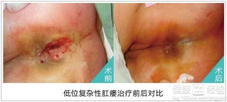 肛瘘术后八大注意事项