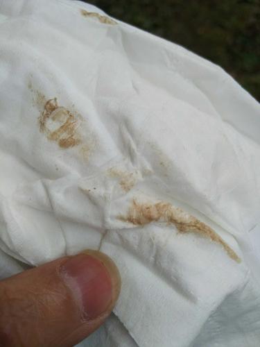 【确诊好孕】今天着床出血为什么有点褐色的血呢?