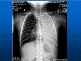 肺不张诊断及鉴别ppt课件下载