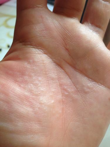 我的手上长了一些小泡泡,特别痒,越挠越多,这种小泡泡叫什么,怎么治?