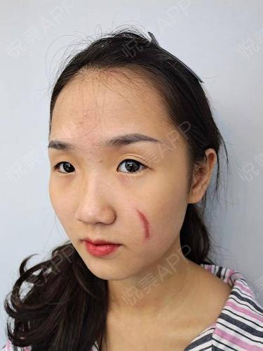 像素激光术后3天_激光祛疤术后3天_去疤痕痘印术后3天_皮肤美容术后3