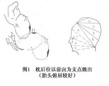 持续性枕后位难产