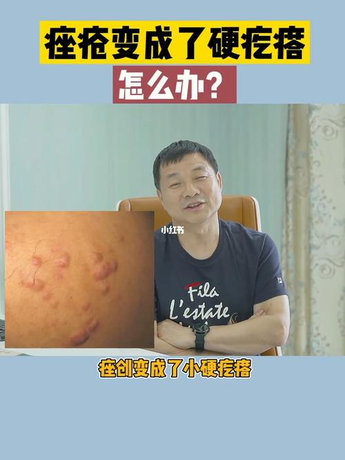 痘痘变成硬疙瘩了怎么办?