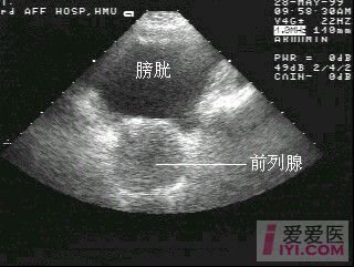 16楼回复飘逸前列腺超声检查测量方法与正常值  正常前列腺的超声测值