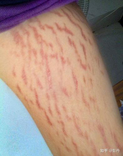 未怀孕女性肚子上有纹是什么原因?