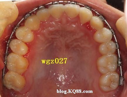 细细品味这2张上颌牙弓图的区别在哪?(原创)