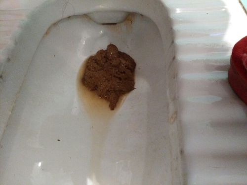 最近十来天天天都拉这样的大便,这是什么情况导致的呢