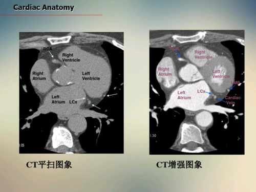 心脏ct断面解剖