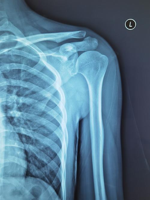 今日病例:肩关节复发脱位术后再脱位的翻修手术