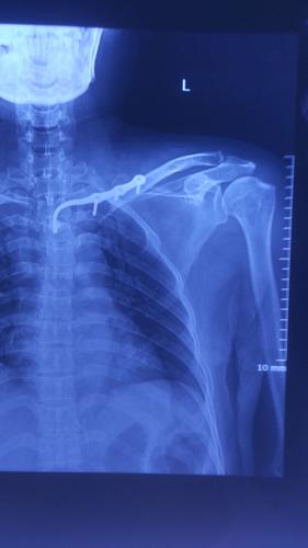 我市首例新型钩钢板治疗胸锁关节脱位