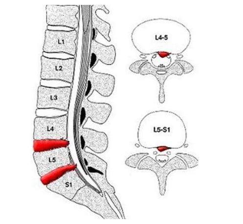 自我确诊腰椎间盘突出的方法?邱氏悬壶