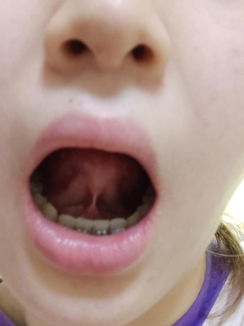 医生说我的舌系带需要剪掉