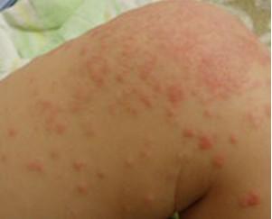 皮炎和过敏的区别 过敏性皮炎的症状体征有哪些