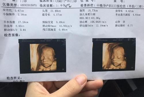 2次四维检查确认是男宝, 孕期症状分享给大家
