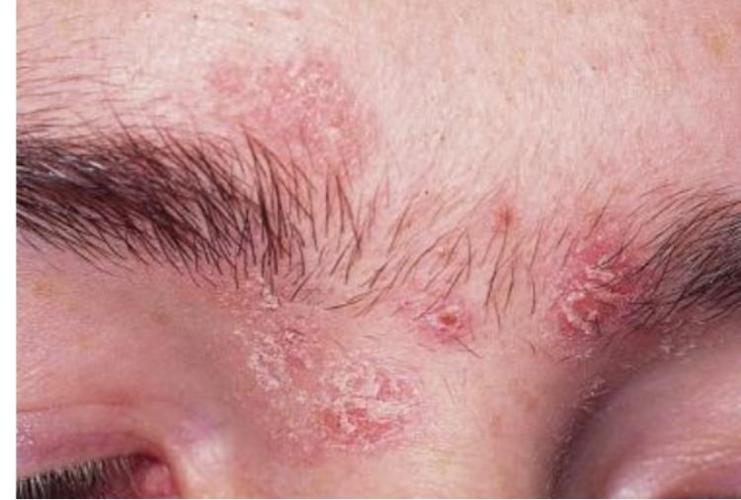 长痘痘总是不好是不是脂溢性皮炎