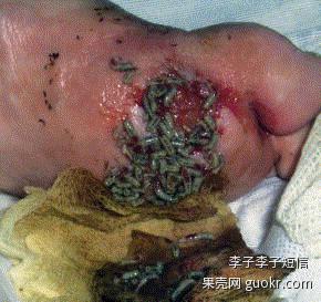 蛆虫清理难以愈合的大型伤口的速度可能超过手术,例如糖尿病患者身上