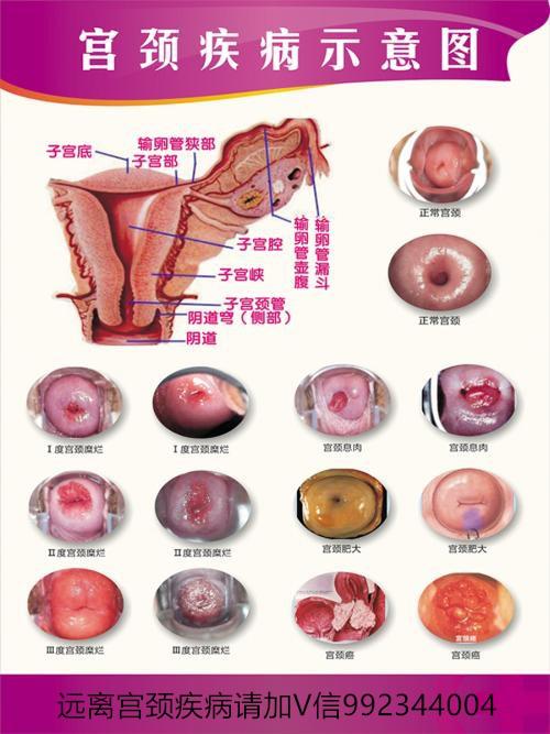 如果您同房出现疼痛,同房出血,接触性出血,那你要注意了,可能宫颈