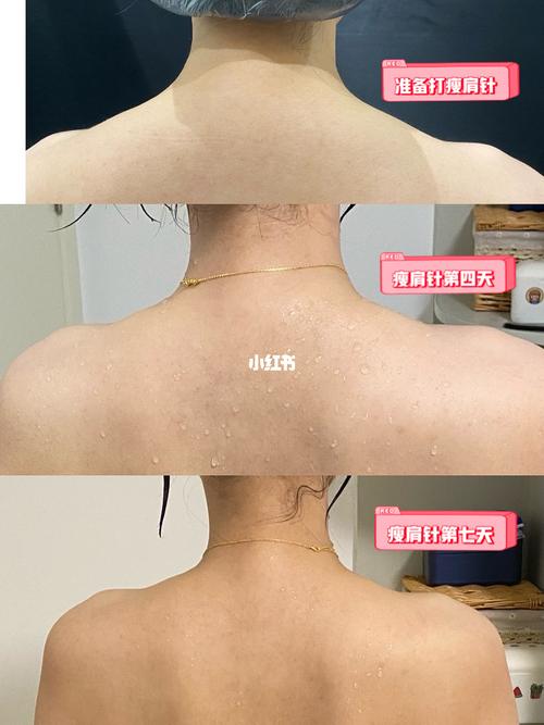 瘦肩针_瘦肩_富贵包_直角肩_瘦肩针_减肥_减肥医药