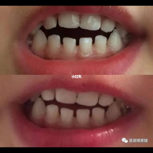 你还在担心安抚奶嘴会导致牙齿畸形吗 看这_安抚奶嘴