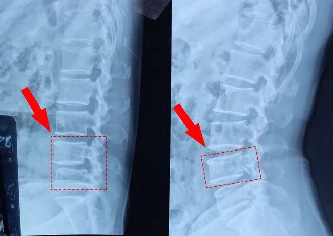 疑难腰椎疾病 | 看微创术如何治疗"腰椎间盘突出,椎管狭窄,椎体滑脱"