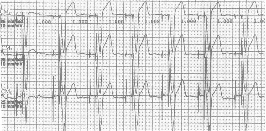 图20-3 双腔起搏心电图