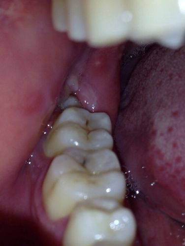 男,25岁,长智齿中,右侧露出小芽.牙龈