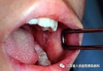 口腔出现koplik斑具有诊断价值.