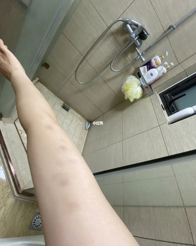 产后45天,手臂这两天疼,果然都青成这样了