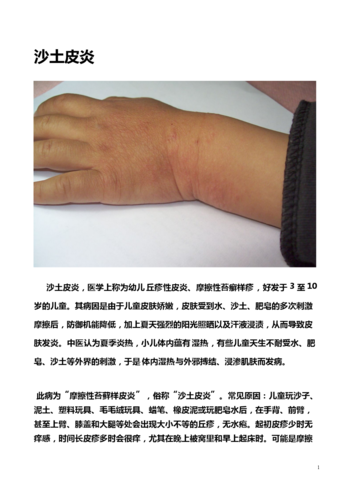 沙土性皮炎(peter仔三次患病的治疗心得)重点分析.doc