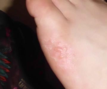 脚上起小水泡很痒怎么办