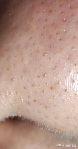 如何区分自己的黑头是螨虫型黑头还是脂栓型黑头?