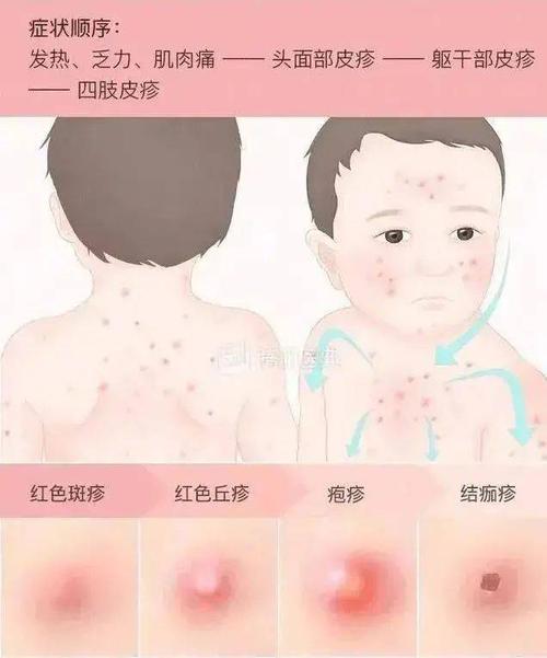 【转需】水痘又来袭!家长们,这些战"痘"知识赶紧备好