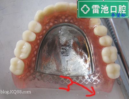 上牙活动义齿设计图