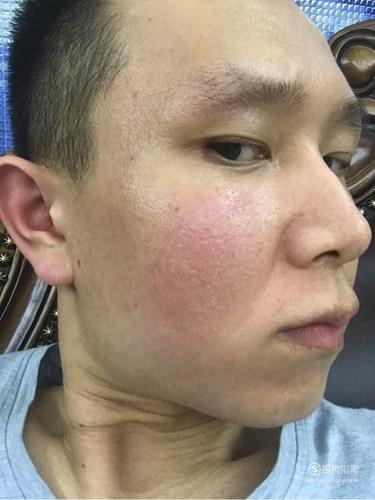 脸上脂溢性皮炎的治疗办法