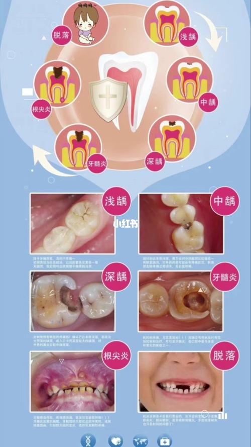 蛀牙是怎么形成的 及如何改善_蛀牙_宝宝健康_母婴