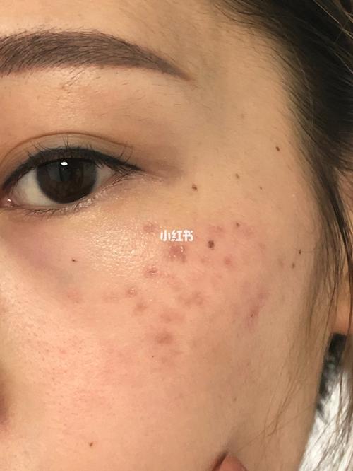 药水点斑结痂脱落后两个多月了红点还是没有消掉 斑也
