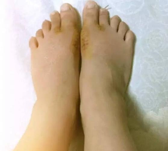 那么拇外翻到底是什么原因导致的呢?