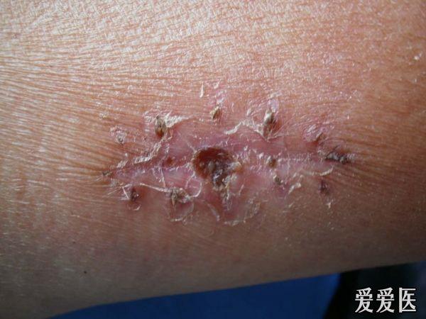 临床见皮肤结核一例