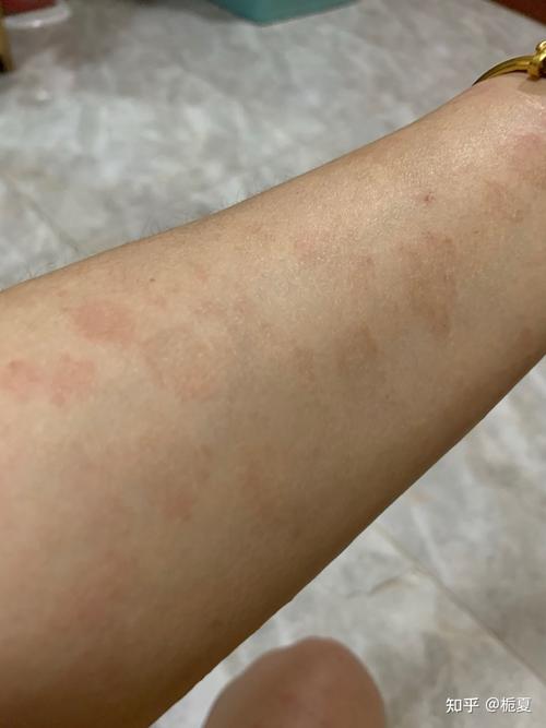 玫瑰糠疹两个多月了还没好