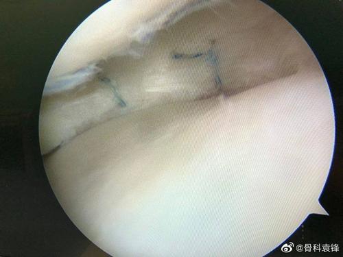 半月板撕裂的缝合