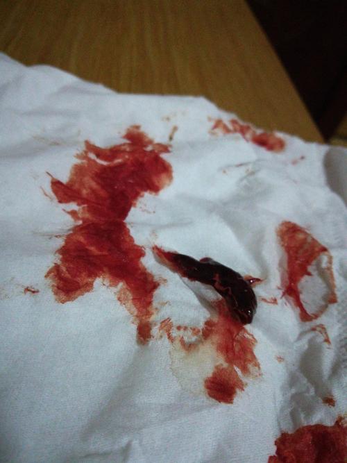 排卵期出血,今天排卵第二天排出一个像肉又不像肉软软