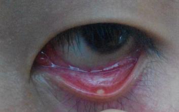 问:下眼皮长了个小白泡,不疼不痒,怎么办?在线等