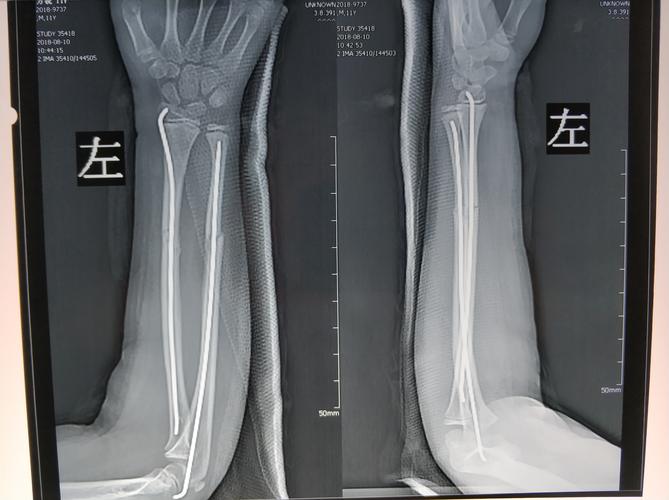 左侧尺桡骨闭合复位弹力髓内钉内固定术