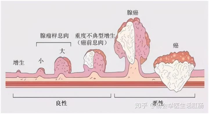 二 肛门息肉是怎么长出来的