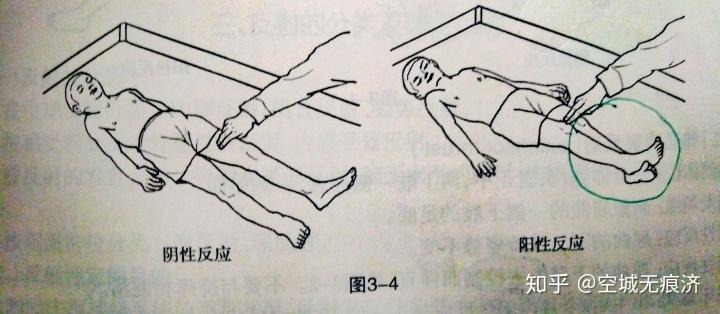 神经反射发育评定