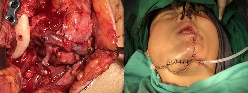 患者女性,年龄29岁,因右下颌骨巨大成釉细胞瘤在当地医院反复3次手术