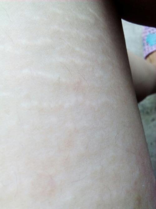 大腿上出现在小条状是白色的