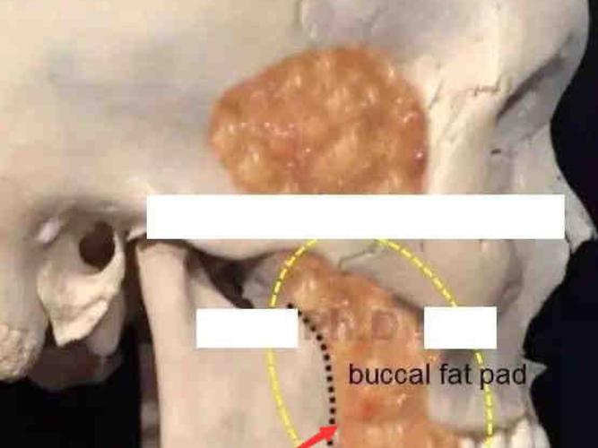 颊脂垫的位置在表层脂肪和smas筋膜层下面,属于深层脂肪团.